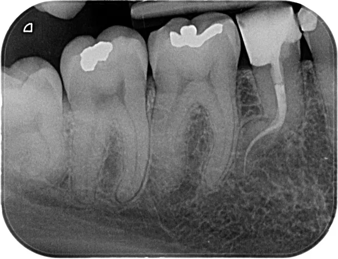 Qu'est-ce-que l'endodontie?