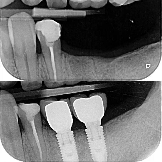 Quel implant dentaire choisir?