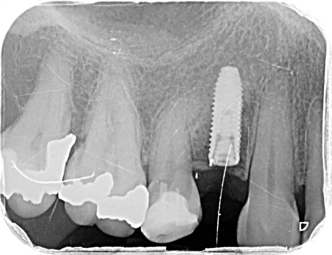 Les implants et prothèses dentaires réalisées par un spécialiste en parodontologie 